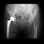 X-ray of a hip replacement