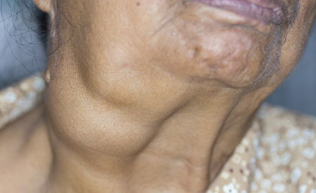 Woman's neck with swelling