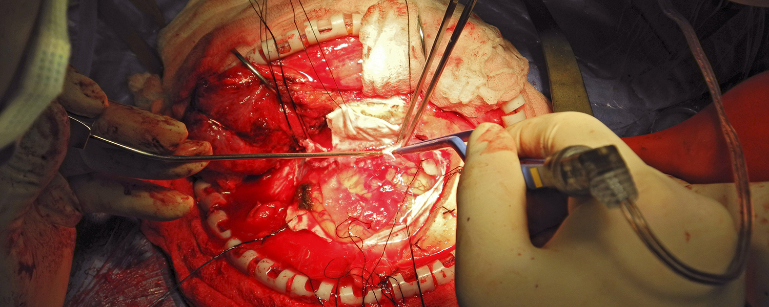 Close-up of brain surgery being performed