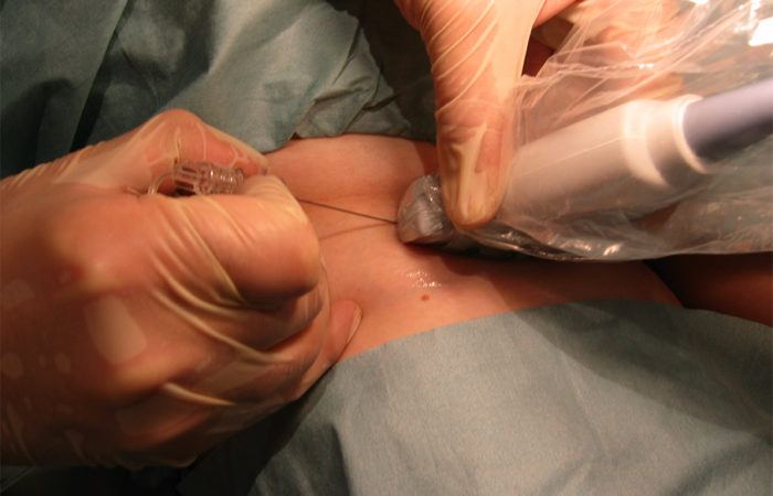 Gloved hands inserting a needle into a patch of exposed skin