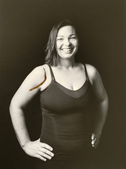 Black and white photograph of smiling woman in sleeveless top, with large scar on her shoulder emphasised in gold