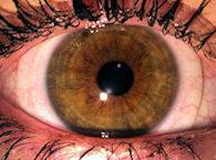 A contact lens in an eye