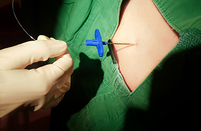 Gloved hand inserts needle in to exposed area of skin