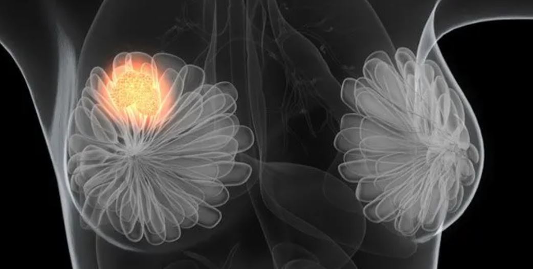 conceptual illustration of breast cancer