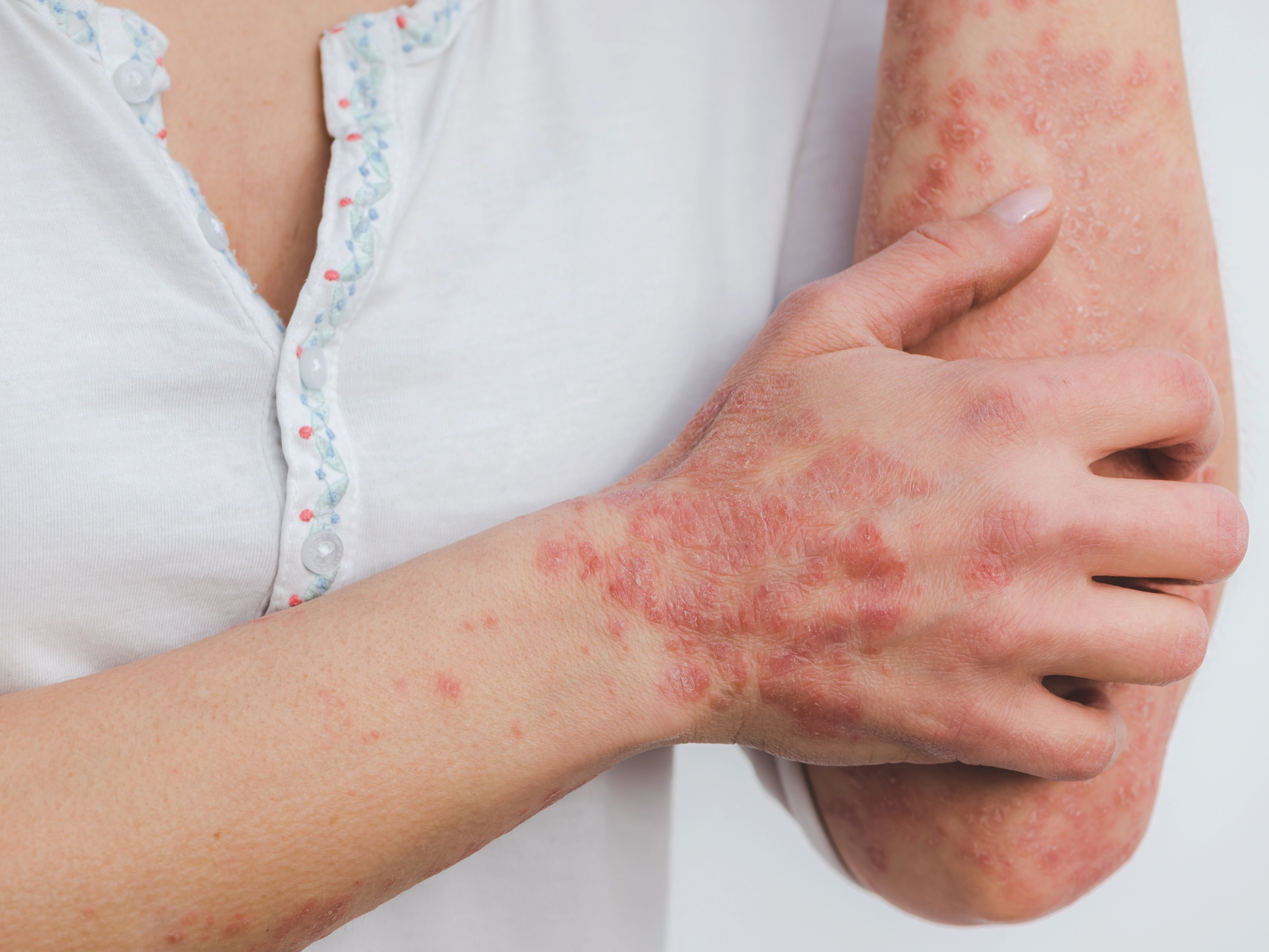 Woman's arms and hands covered in rash