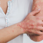 Woman's arms and hands covered in rash