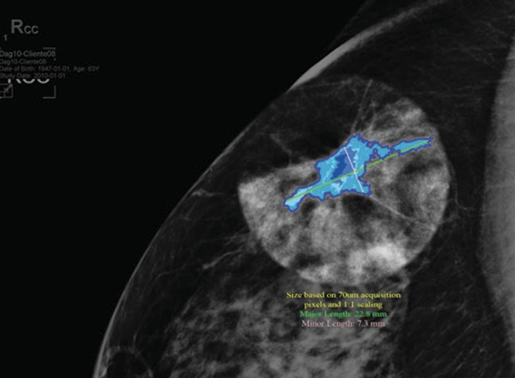 Mammogram image showing tumour highlighted