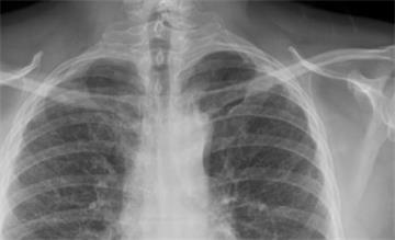 A chest X-ray