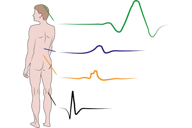 Evoked Potential Studies (EPS)