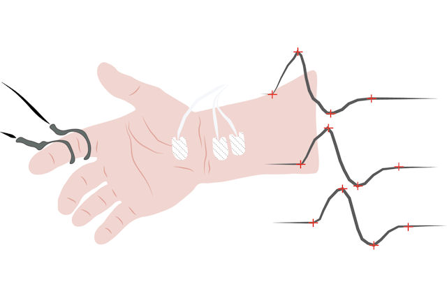 Nerve Conduction Studies (NCS) and Electromyography (EMG)